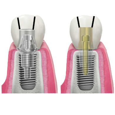 restaurări protetice înșurubate argon dental